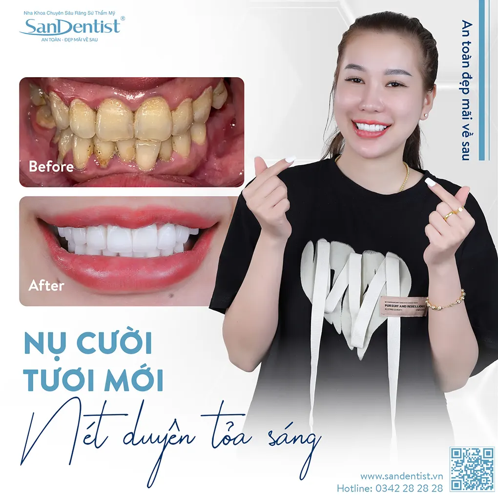 Phương pháp trám răng Inlay/Onlay là gì?