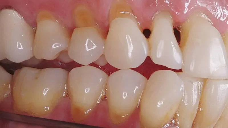 Răng bị mục: Nguyên nhân và cách khắc phục