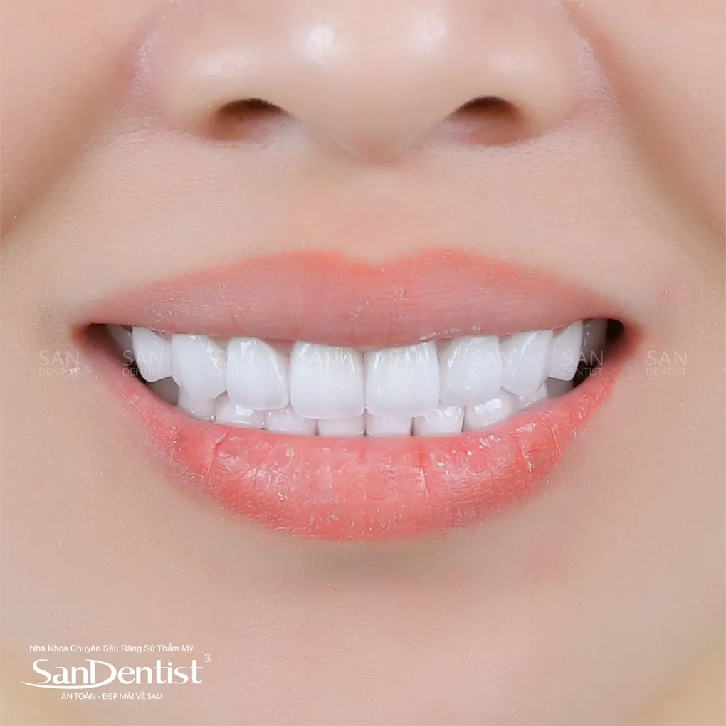 Răng bị mục: Nguyên nhân và cách khắc phục