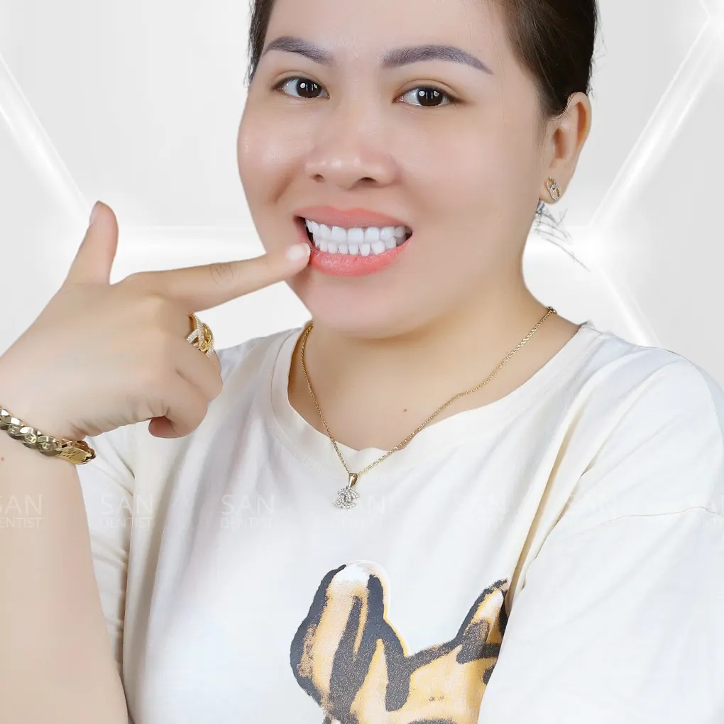 Răng khôn bị sâu cần xử lý như thế nào?