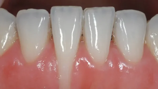 Tiêu xương ổ răng cần được xử lý như thế nào?