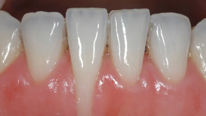 Tiêu xương ổ răng cần được xử lý như thế nào?