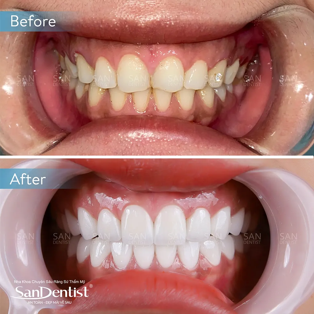 Viêm nướu răng uống thuốc gì cho nhanh khỏi?