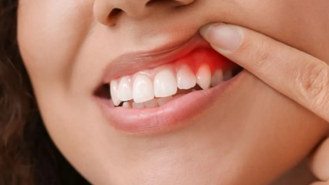 Viêm nướu răng uống thuốc gì cho nhanh khỏi?