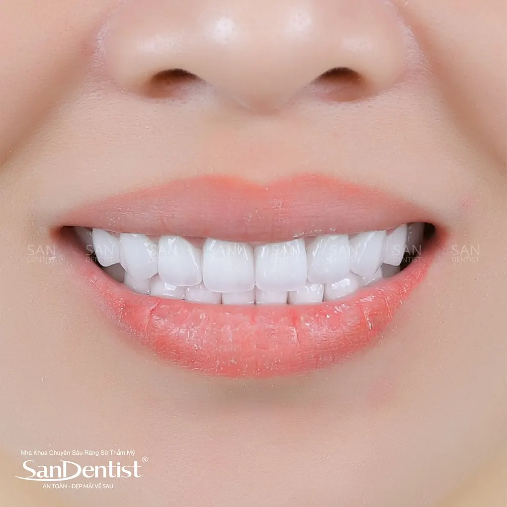 Viêm nướu răng uống thuốc gì cho nhanh khỏi?