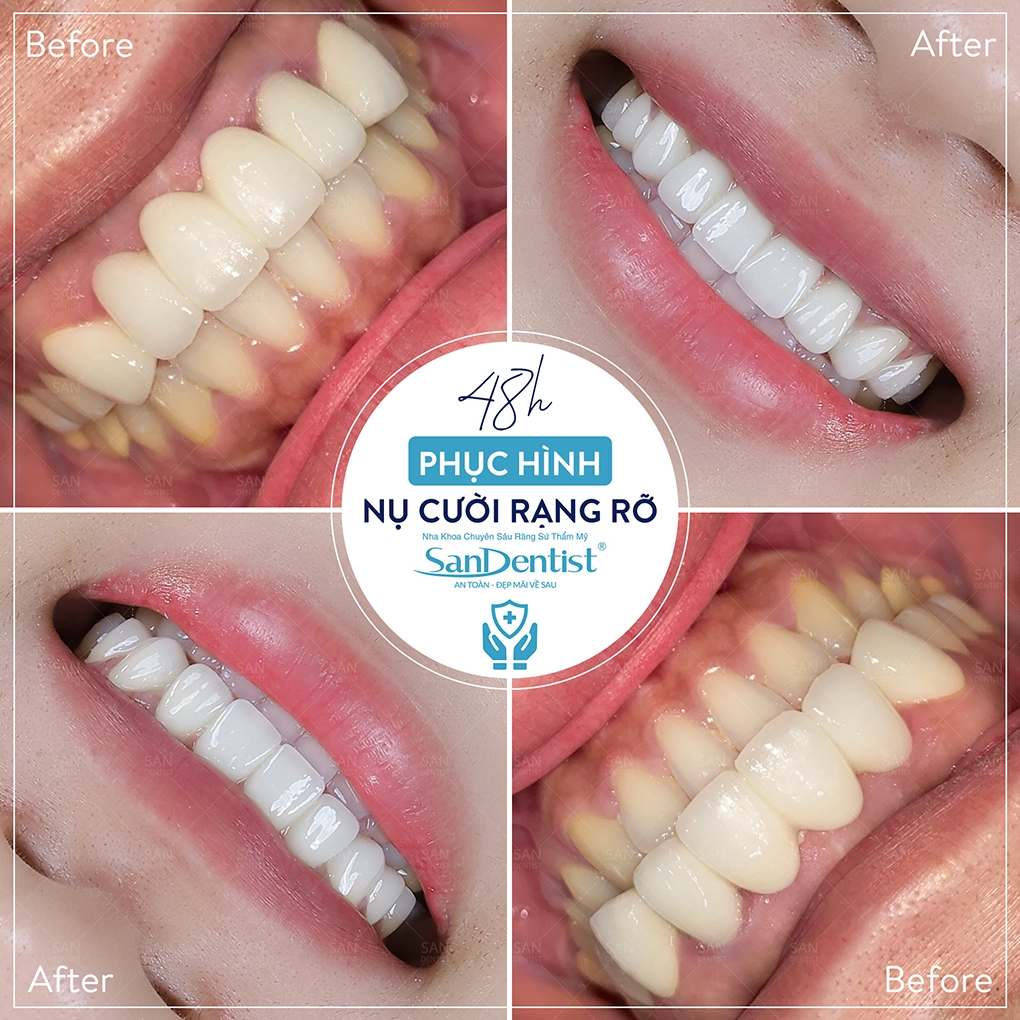 4 tác hại của việc trám răng sai kỹ thuật