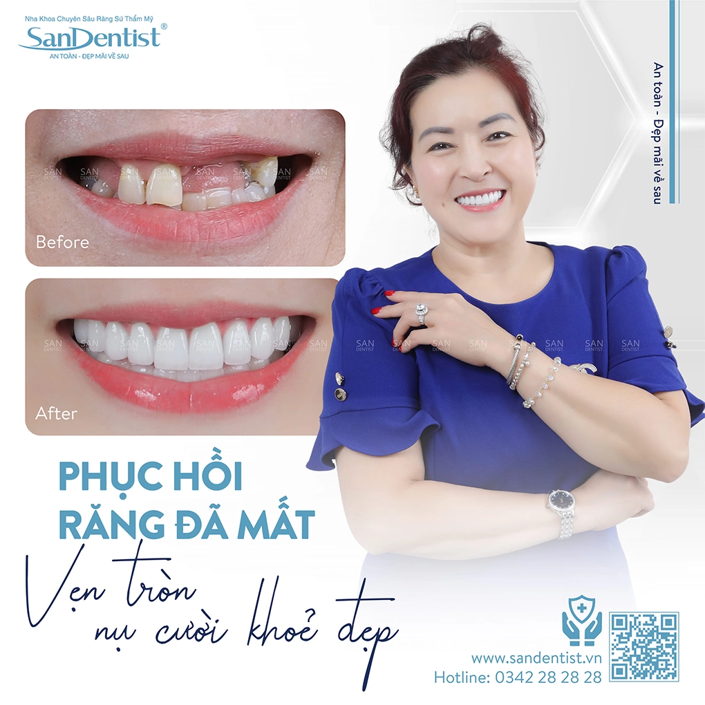 4 tác hại của việc trám răng sai kỹ thuật