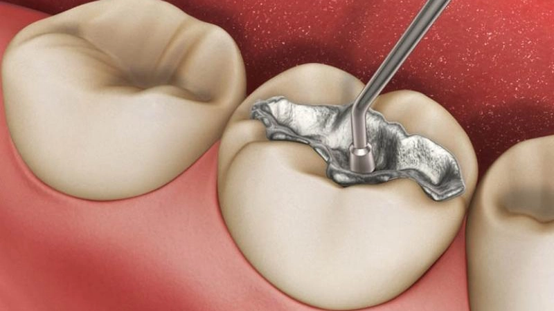 4 tác hại của việc trám răng sai kỹ thuật