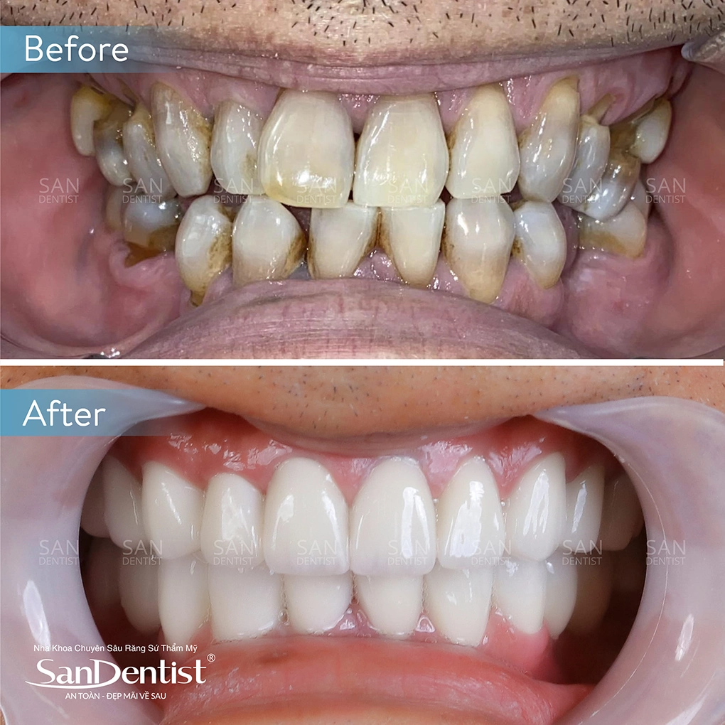 4 tác hại của việc trám răng sai kỹ thuật