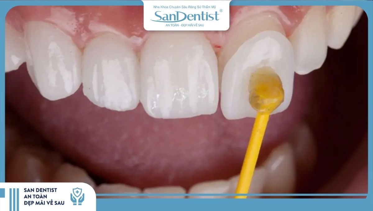 Dán sứ không cần mài răng_mài rất ít