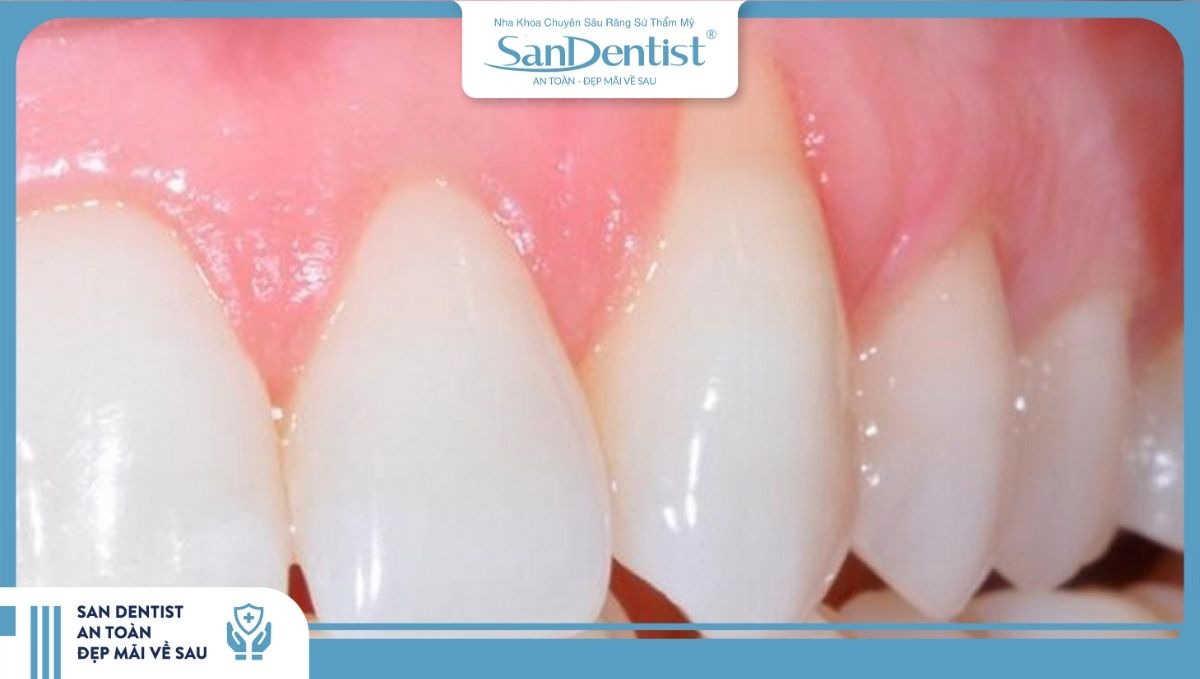 Sử dụng mão sứ kém chất lượng là nguyên nhân bọc răng sứ bị tụt lợi