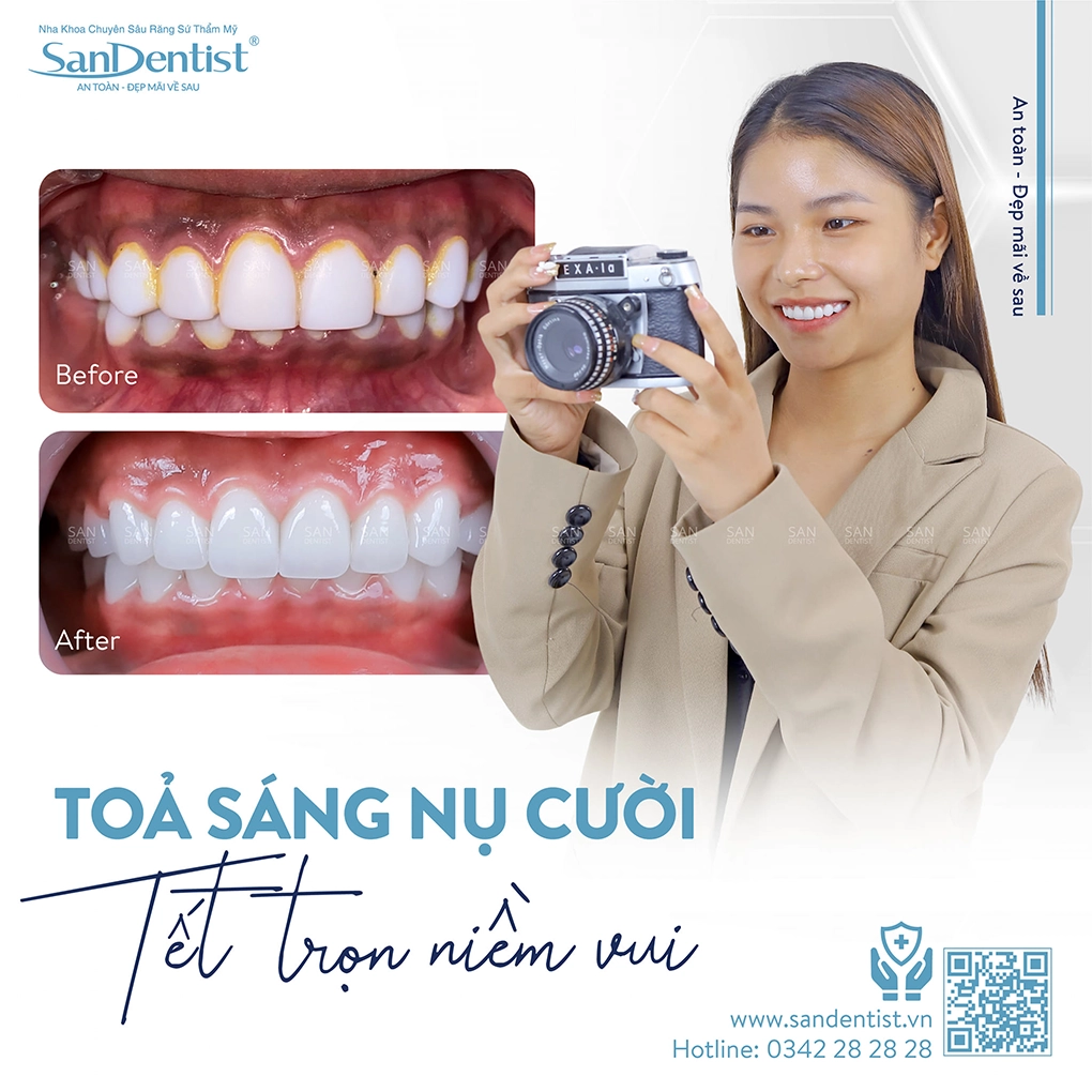 Bài tập há miệng sau khi nhổ răng khôn