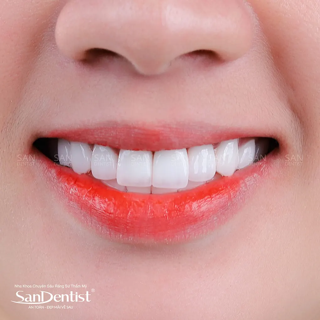 Bệnh áp xe nha chu có nguy hiểm không?