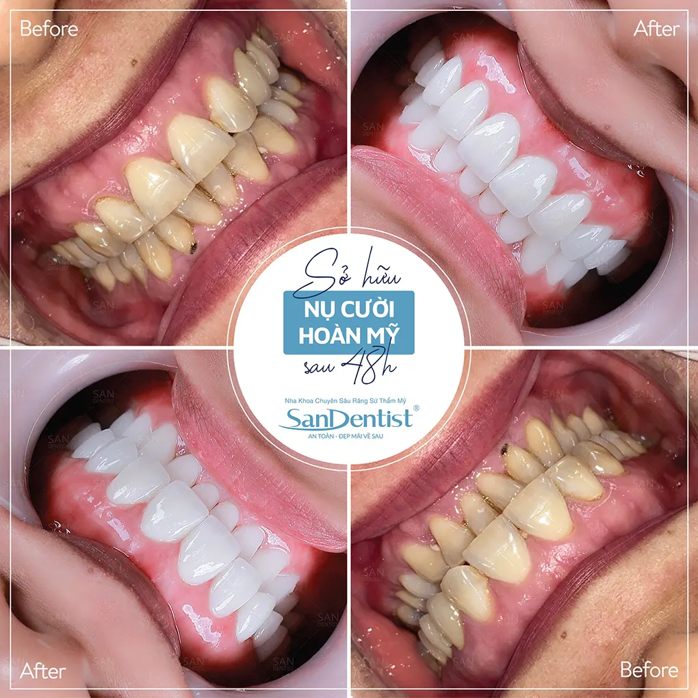 Bệnh áp xe nha chu có nguy hiểm không?