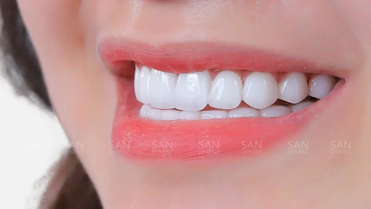 Bệnh áp xe nha chu có nguy hiểm không?