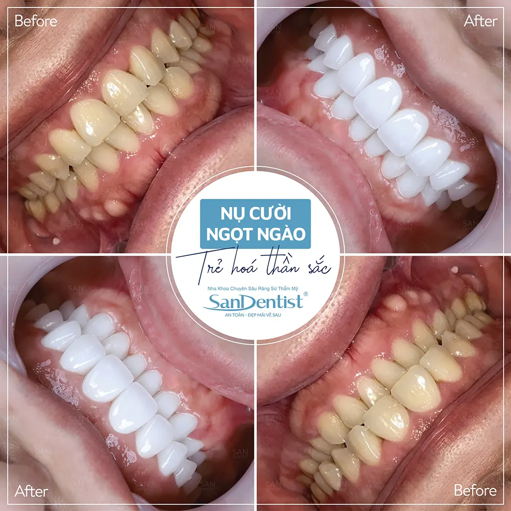 Cách duy trì sức khỏe răng miệng trong mùa hè