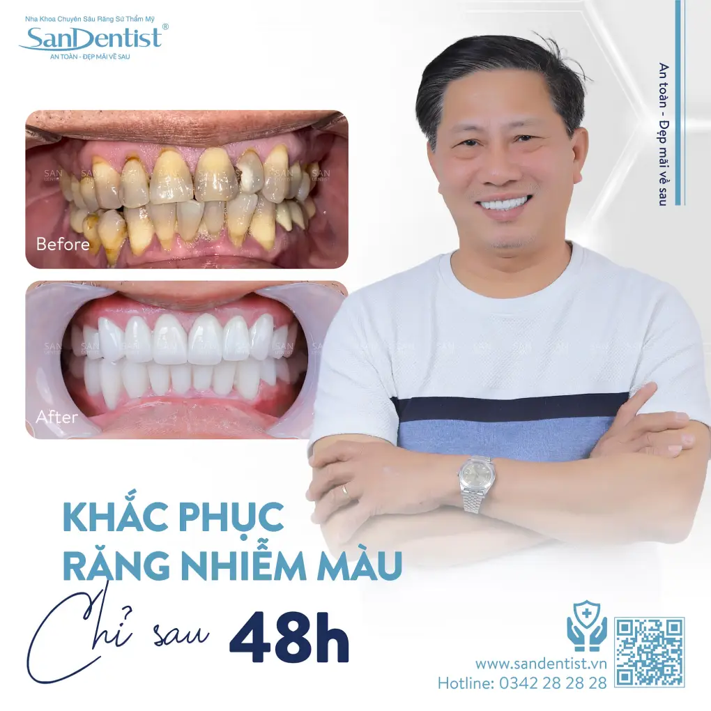 Dấu hiệu răng sứ bị hở và cách khắc phục