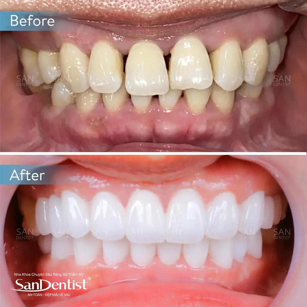 Dấu hiệu răng sứ bị hở và cách khắc phục