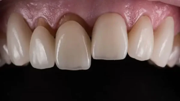 Dấu hiệu răng sứ bị hở và cách khắc phục