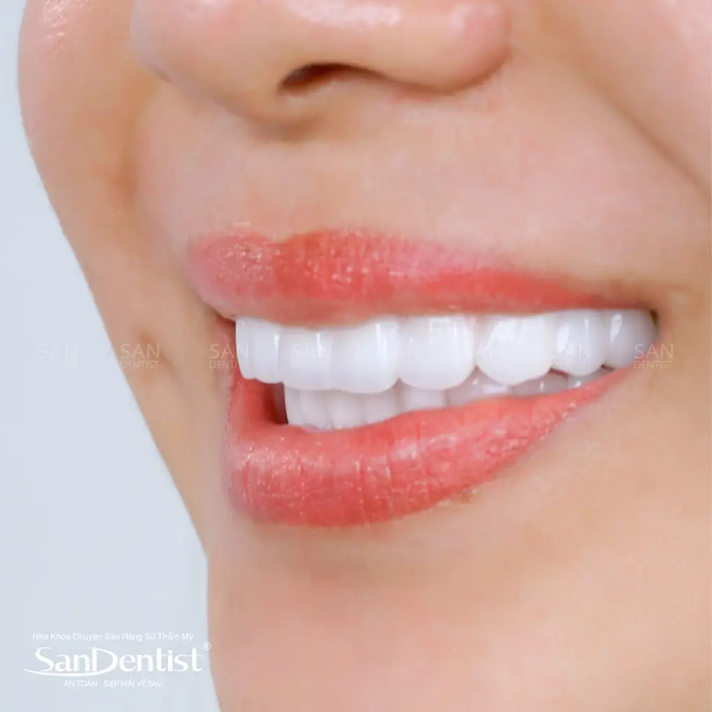 Dấu hiệu răng sứ bị hở và cách khắc phục