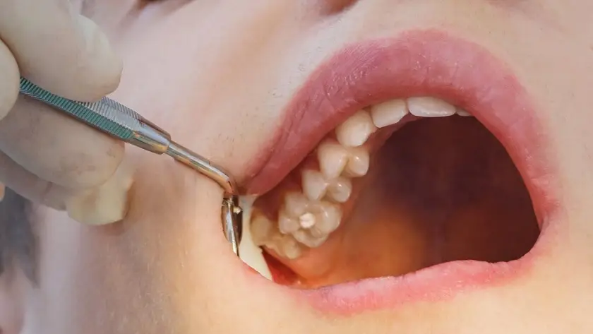 Không nhổ răng số 8 hàm trên có gây nguy hiểm?