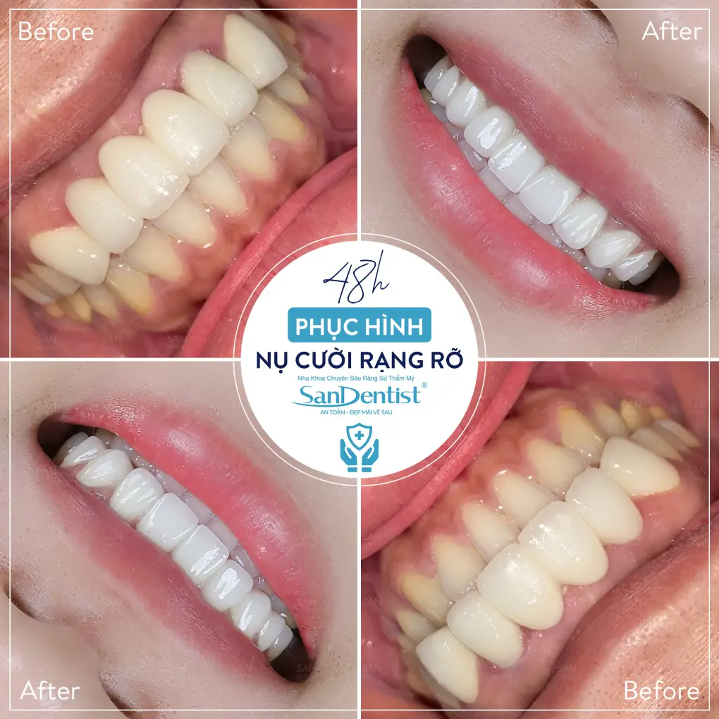 Không nhổ răng số 8 hàm trên có gây nguy hiểm?