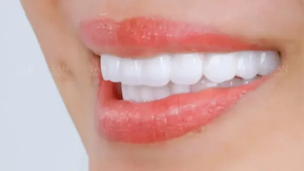 Làm răng veneer giá bao nhiêu (cập nhật mới nhất 2024)