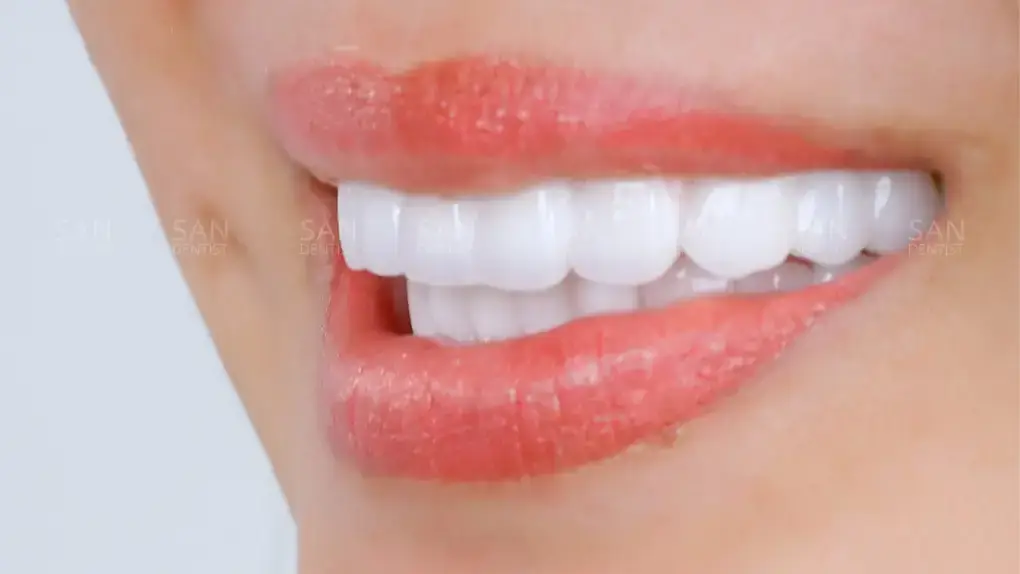 Làm răng veneer giá bao nhiêu (cập nhật mới nhất 2024)