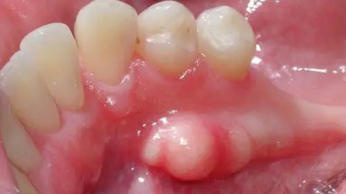 Lồi xương hàm dưới có gây nguy hiểm không?