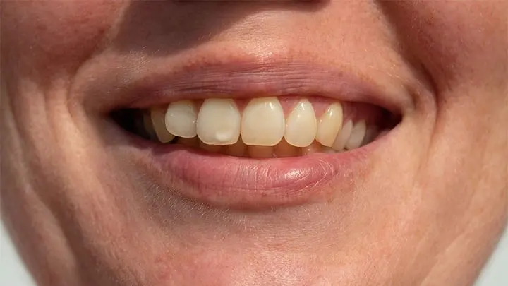 Răng có đốm trắng: Điều trị và ngăn ngừa ra sao?