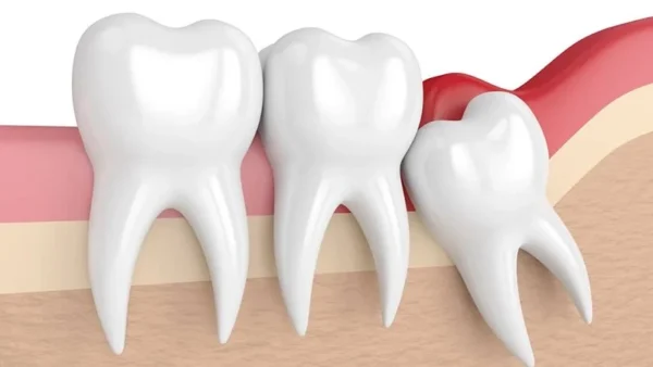 Răng khôn mọc mấy lần trong đời?