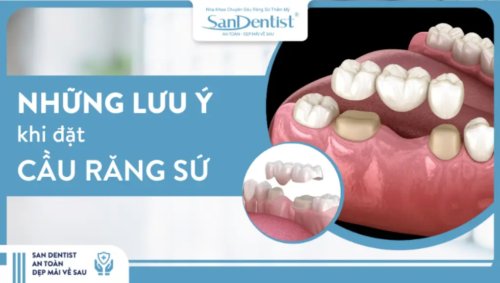 Những lưu ý khi đặt cầu răng sứ
