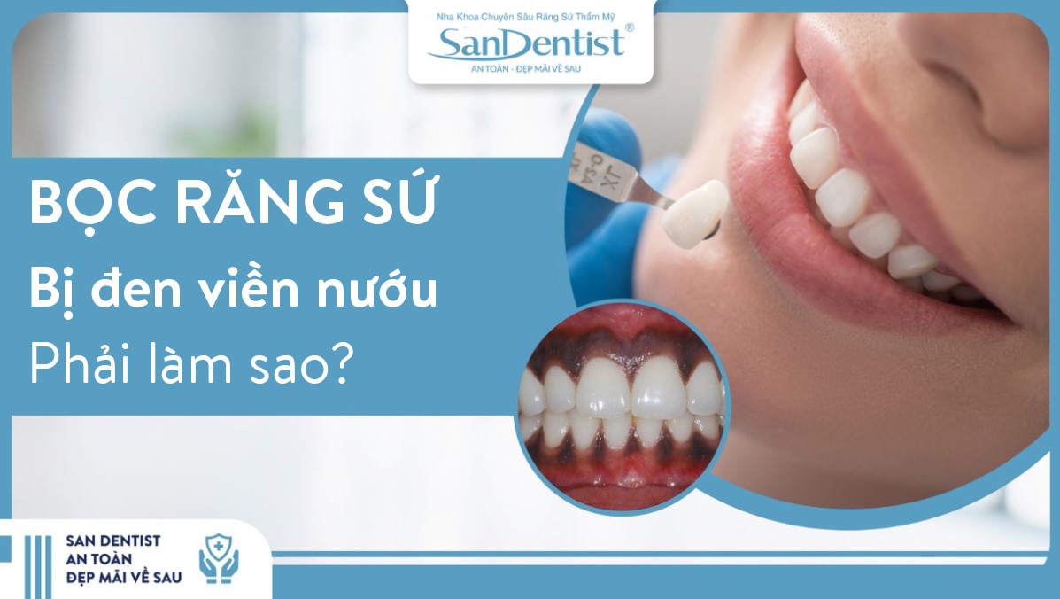 Bọc răng sứ bị đen nướu