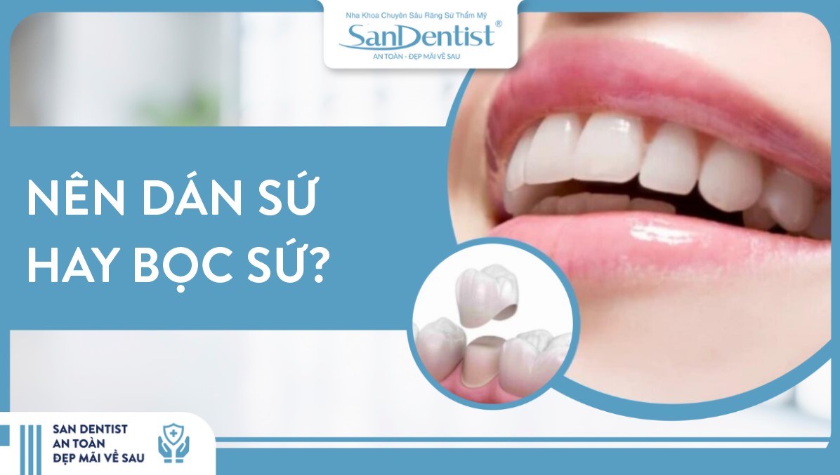 Nên dán sứ hay bọc sứ