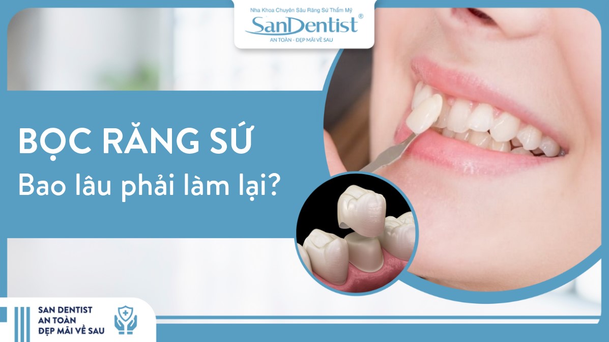 Bọc răng sứ bao lâu thì phải làm lại