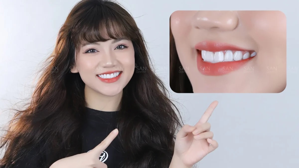 Làm răng sứ ở đâu tốt nhất TPHCM, bọc răng sứ tphcm