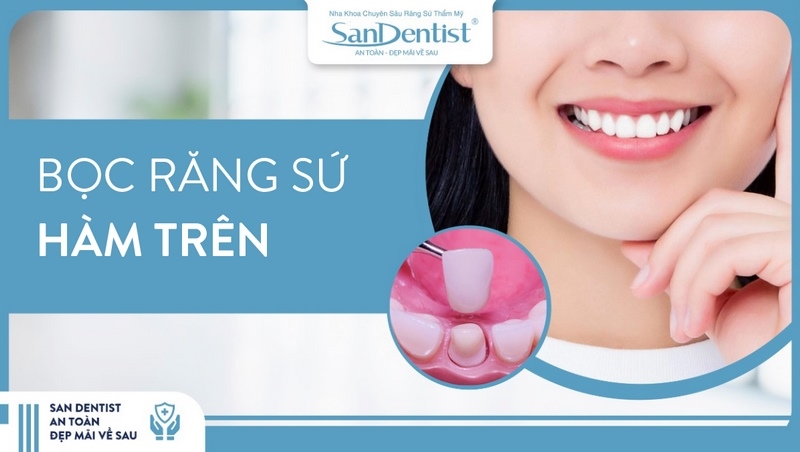 bọc răng sứ hàm trên