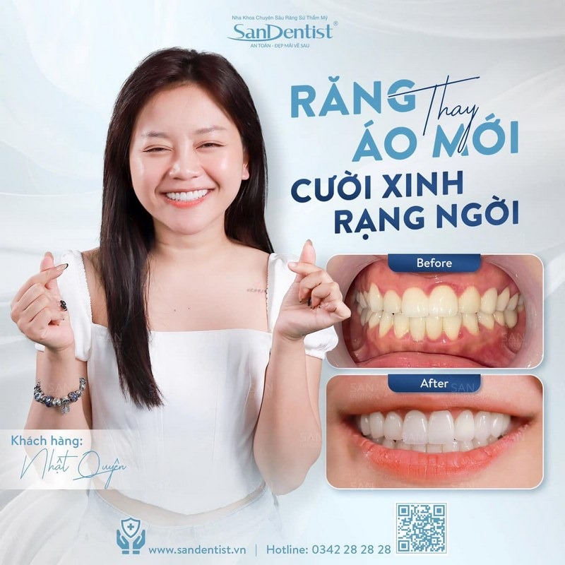 Khách bọc răng sứ tại Nha khoa San Dentist