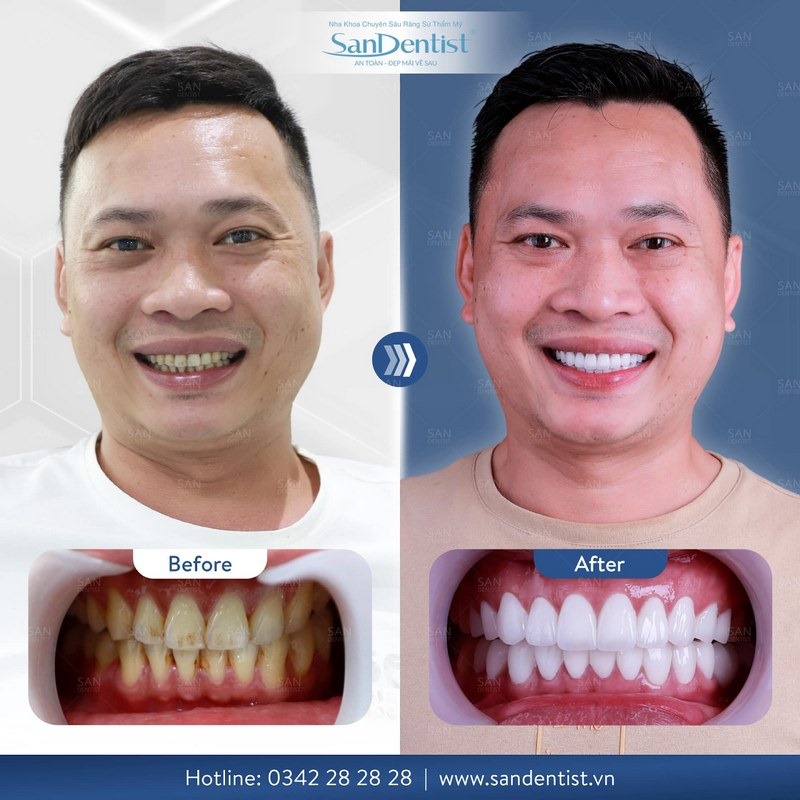 Khách bọc răng sứ tại Nha khoa San Dentist