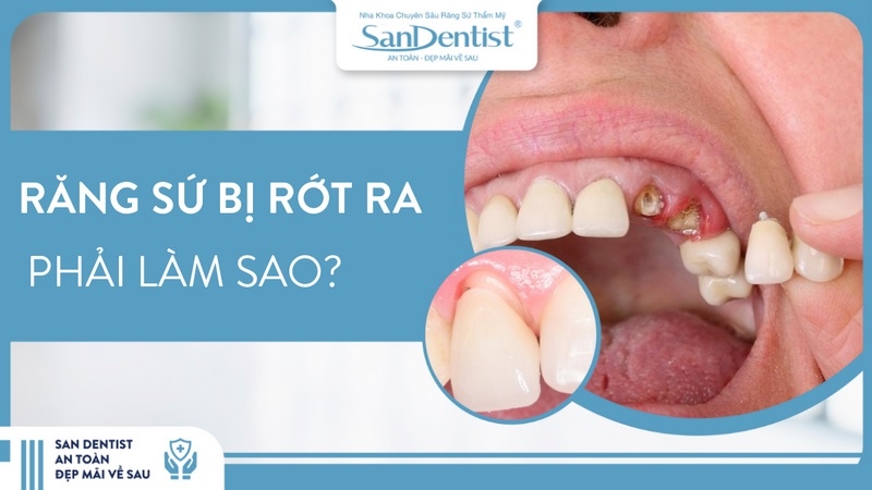 răng sứ bị rớt ra