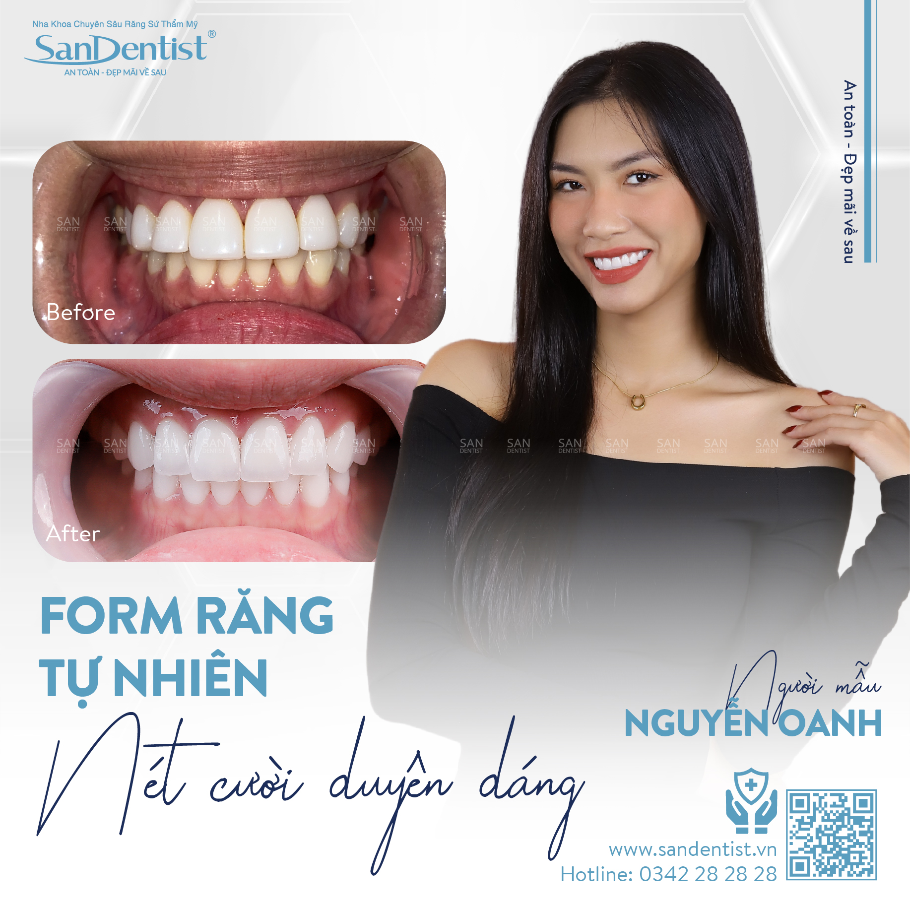 Người mẫu Nguyễn Oanh – khách hàng San Dentist