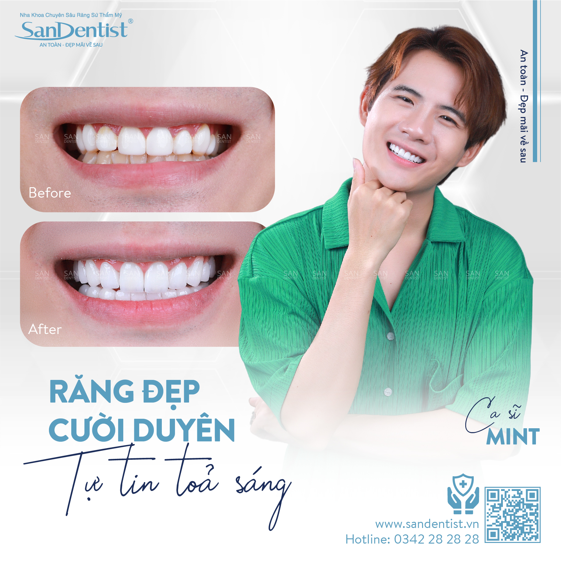 Ca sĩ MinT – khách hàng San Dentist