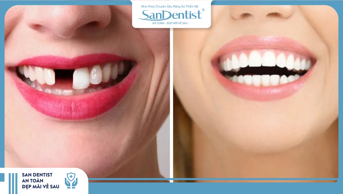 Giá bọc răng sứ Orodent nguyên hàm được ưu đãi hơn so với mức giá lẻ