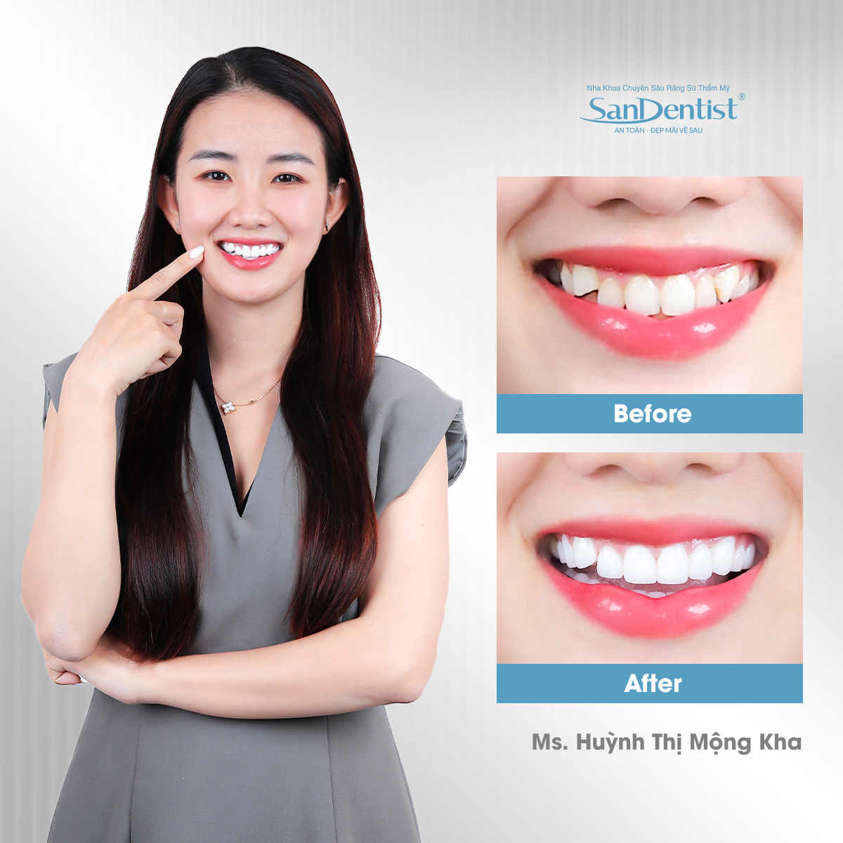 Trồng răng implant nghỉ dưỡng 5 sao