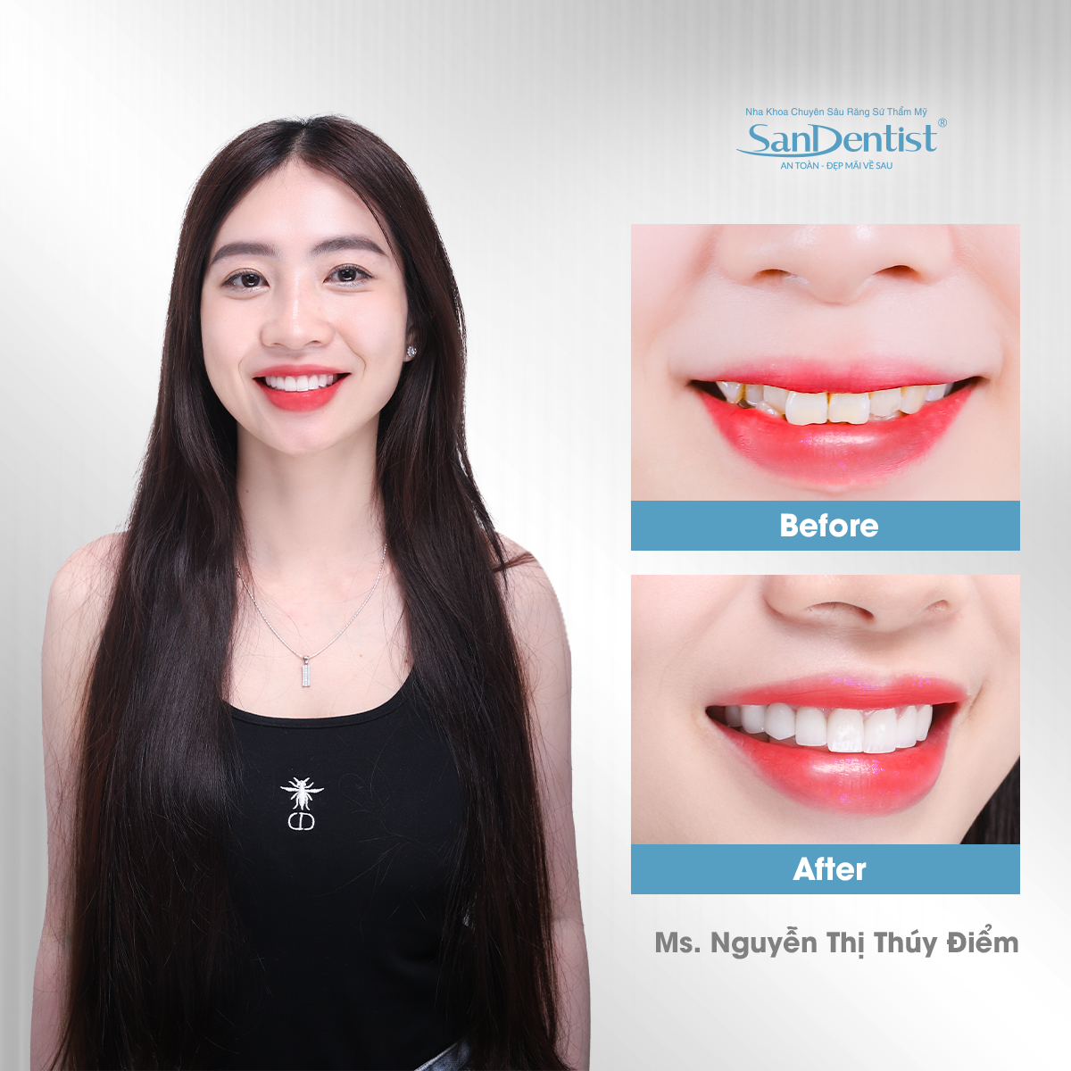 Trồng răng implant nghỉ dưỡng 5 sao