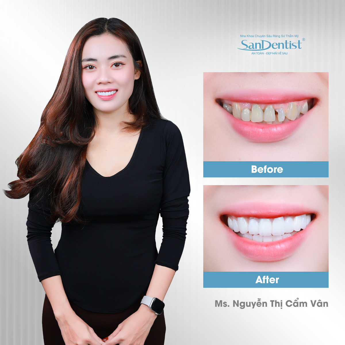 Trồng răng implant nghỉ dưỡng 5 sao