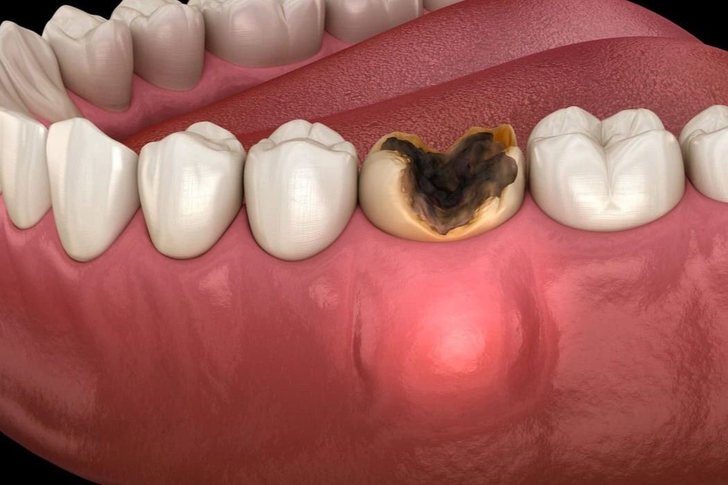 áp xe răng - hình 2