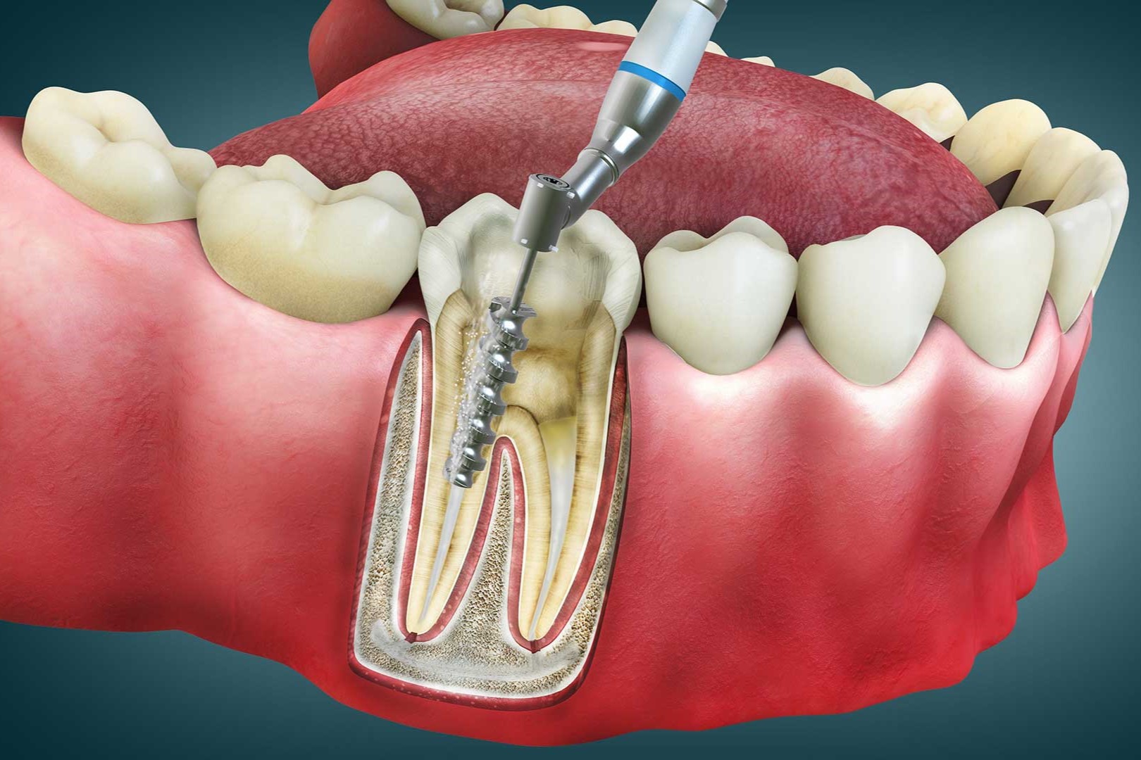 áp xe răng - hình 3