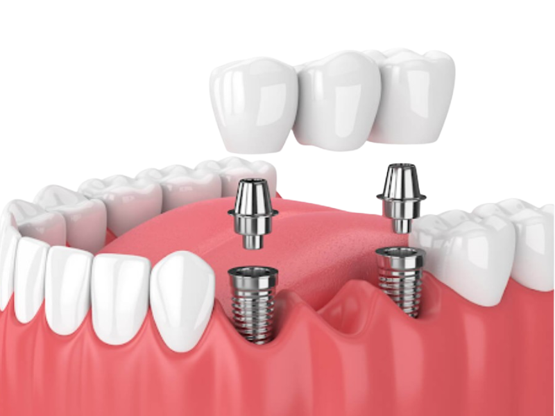 Trồng răng Implant là gì? Quy trình 5 bước chi tiết từ A-Z