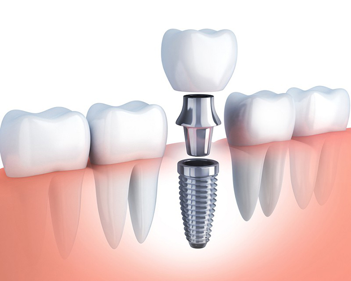 Trồng răng Implant là gì? Quy trình 5 bước chi tiết từ A-Z